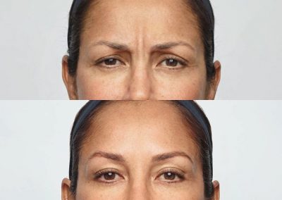 Botox Dysport Before and After - Anne Therese - Gahanna and Lewis Center, Ohio
