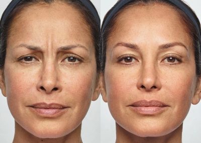Botox Dysport Before and After - Anne Therese - Gahanna and Lewis Center, Ohio