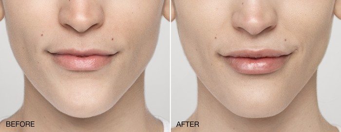 Dermal Filler Before and After - Anne Therese - Gahanna and Lewis Center, Ohio