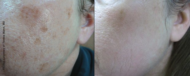 Before and After Brown Spots - Anne Therese - Gahanna and Lewis Center, Ohio