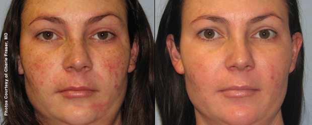 Before and After Acne Treatment - Anne Therese - Gahanna and Lewis Center, Ohio