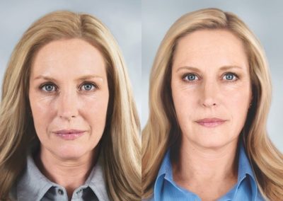 Sculptra Before and After - Anne Therese - Gahanna and Lewis Center, Ohio