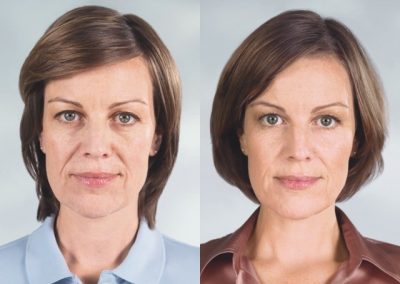 Sculptra Before and After - Anne Therese - Gahanna and Lewis Center, Ohio