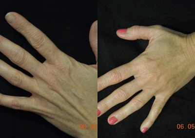 Bellafill Hand before and after - Anne Therese - Gahanna and Lewis Center, Ohio