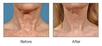 Before and After Neck Skin Tightening - Anne Therese - Gahanna and Lewis Center, Ohio