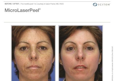 MicroLaserPeel Before and After - Anne Therese - Gahanna and Lewis Center, Ohio