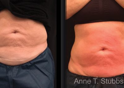 Liposuction - Anne Therese - Gahanna and Lewis Center, Ohio